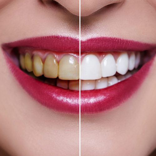 Tooth Bleaching Tooth Bleaching