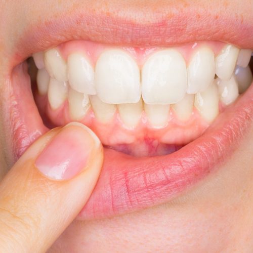 Diş Eti Hastalıkları Tanı ve Tedavileri Diş Eti Hastalıkları Tanı ve Tedavileri