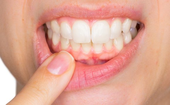 Diş Eti Hastalıkları Tanı ve Tedavileri
