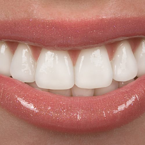 Gummy Smile Tedavisi Gummy Smile Tedavisi